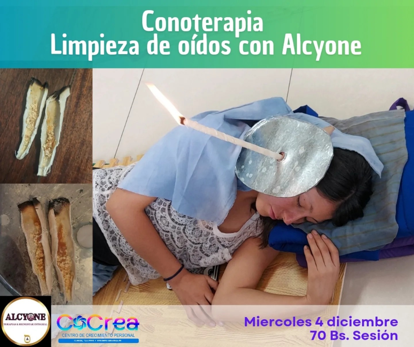 Conoterapia con Alcyone